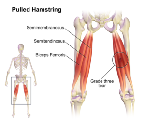 IMAGE: Hamstring Pull