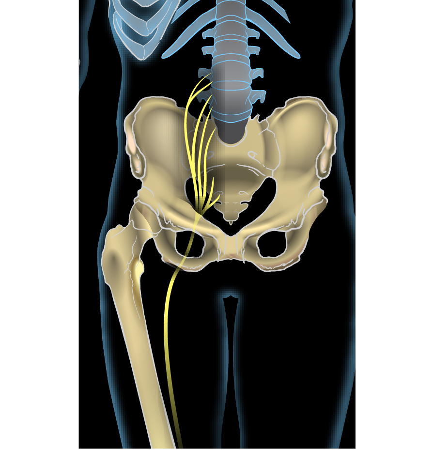 Sciatica & Radiating Leg Pain – Bild Clinic